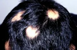 alopecia