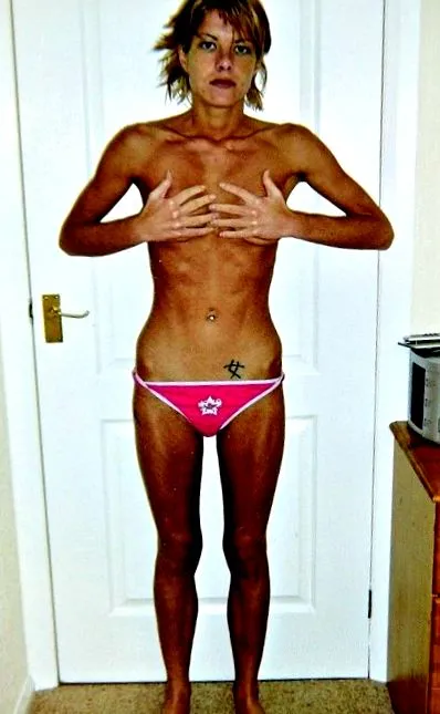 galben anorexică