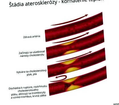 ateroscleroza