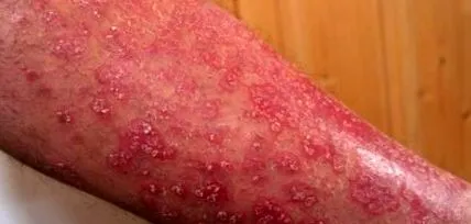 psoriazisul sever