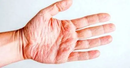 eczema sarcinii