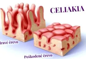 celiace celiace