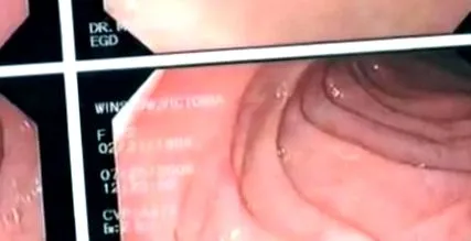 celiaca