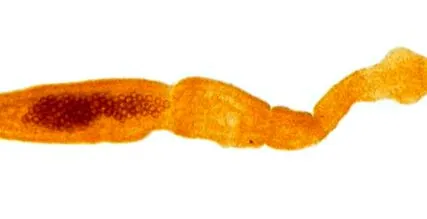 echinococozei alveolare