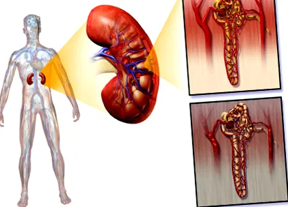 diabetica