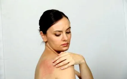 eczemele