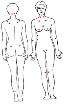 fibromialgia
