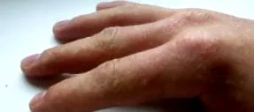 eczema dishidrotică