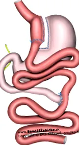 gastric