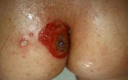 impetigo piele
