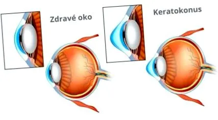 keratoconus