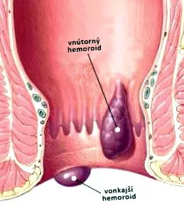 hemorf