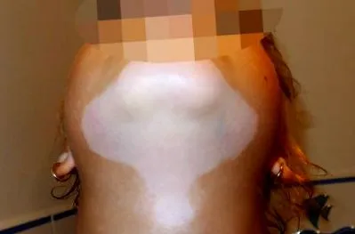 vitiligo vitiligo