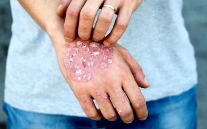 adulți psoriazis