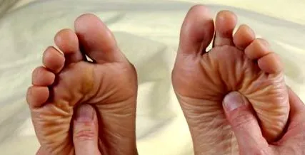 acupunctură