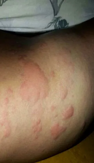 blue urticaria