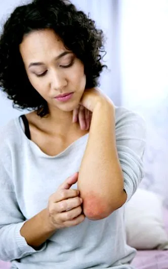 simptomele psoriazisului