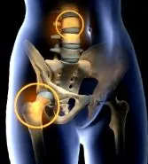 osteoartritei liga