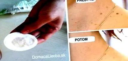 îndepărtați negii