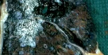 pneumoconiozei
