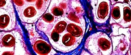 chistului hepatic