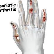 psoriatic reuma