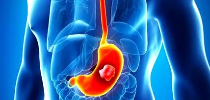 cancerul stomac