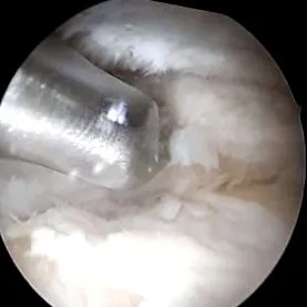 arthroscopy-kezelés
