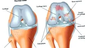 térdízületi osteoarthritis tünetek