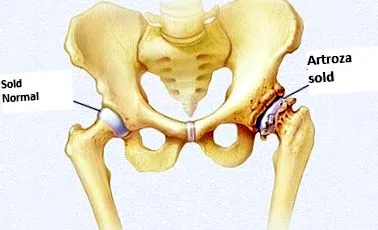 osteoartróza