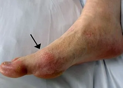 palca