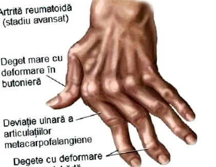 osteoarthritisének deformáló