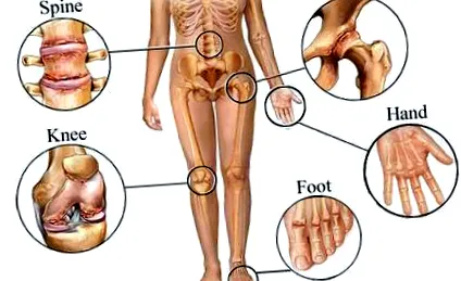 osteoarthritisje