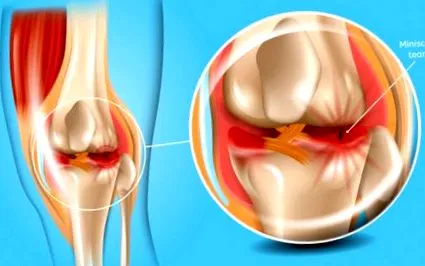 synovitis