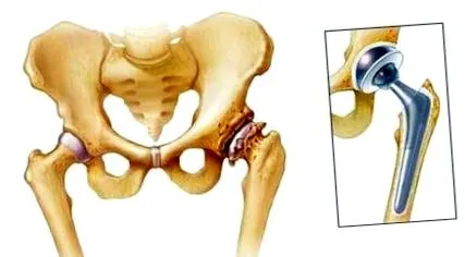 artroplastika