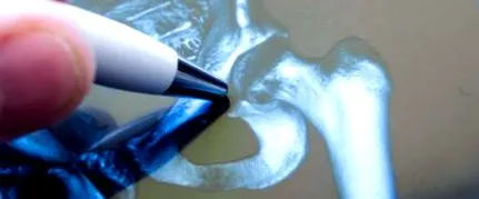 osteoarthritisje könyökízület