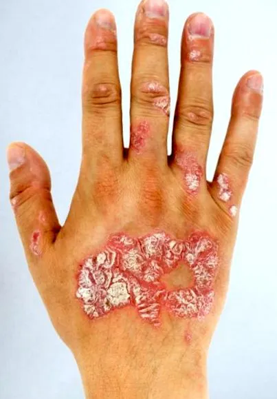 laserderma