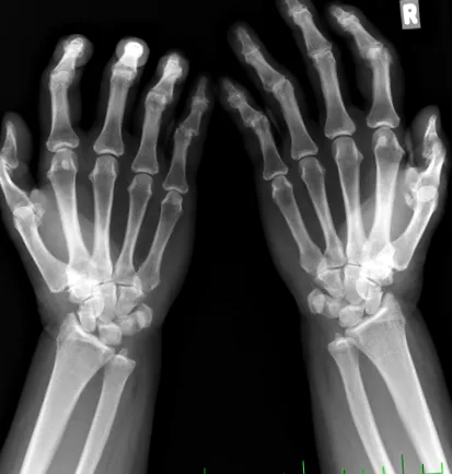 osteoartrita reumatoidă