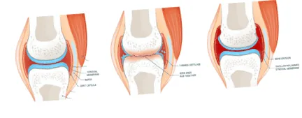 simptome reumatism
