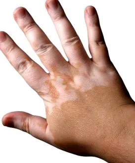 Vitiligo este