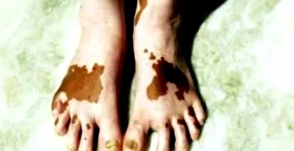 vitiligo
