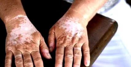 pigmentul vitiligo