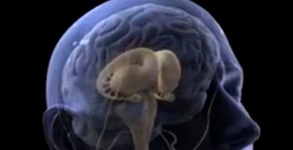 meningitis