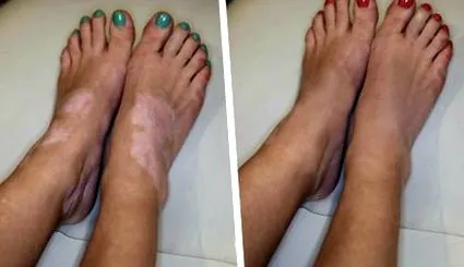 vitiligo