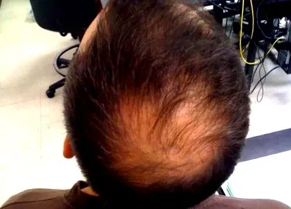 Alopecia androgenă