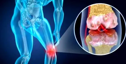 osteoarthritis