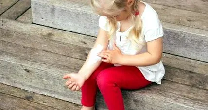 eczema eczema
