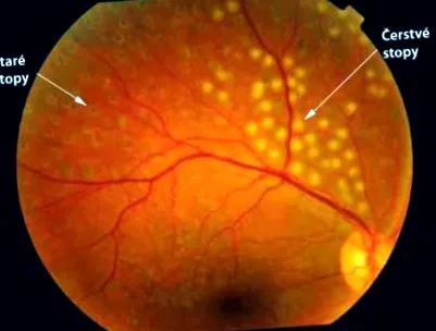 retinopatia diabetică