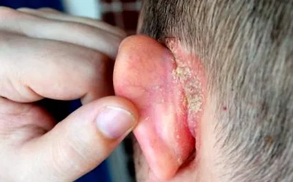 psoriazisului biologic