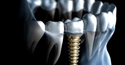 fogászati ​​implantátum